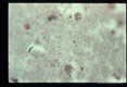 Brain with trophozoites, H & E.