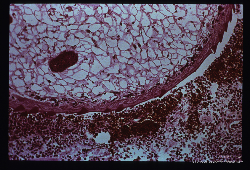 Adult embedded in intestinal wall. The parasite presents as an oval to round mass limited by a spined cuticle. The parasitic parenchyme is punctuated by multiple sections through gut (reddish-brown). The two centrally located tubular structures, separated by a light staining muscular sucker, are part of the reproductive apparatus of the parasite. A marked inflammatory response is present in the adjacent host tissues and fresh red blood cells can be seen near the parasite.