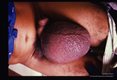 Inguinal adenopathy plus enlargement of male genitalia.