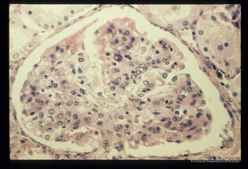 Nephropathy in chimpanzee with pipe stem fibrosis. Note mesangial proliferation.