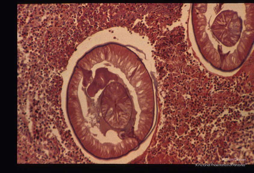 Another case from Holland. Low and high power magnifications of worms in stomach wall.