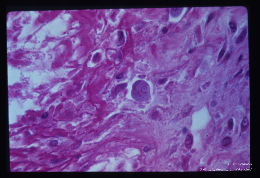 Trophozoite in submucosa of colon.