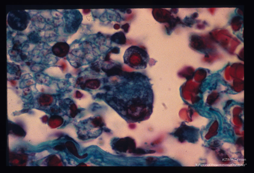 Pneumonia. Oil immersion view of alveolus stained by the Wheatly modification of trichrome for stools showing macrophage invasion and parasites.