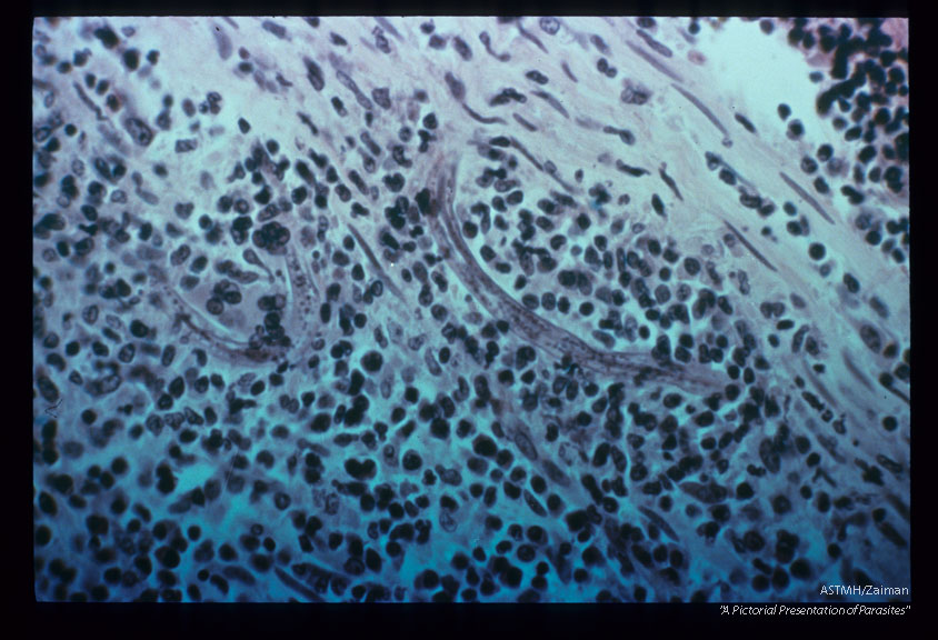 Larval forms invading sub-mucosa. Marked inflammatory response.