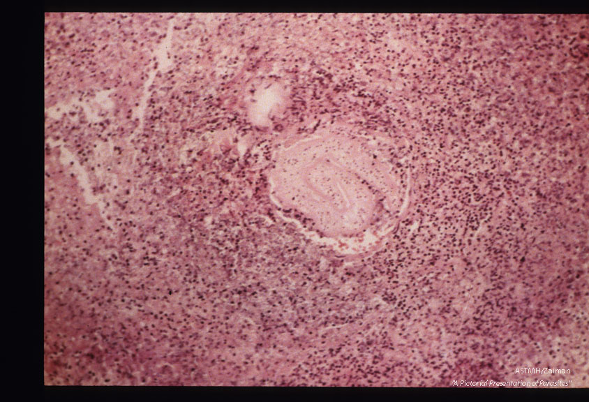 Necrotic pulmonary reaction.