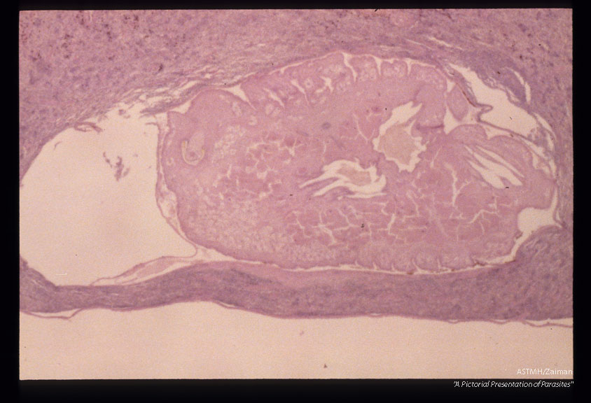 Nymphs in liver.