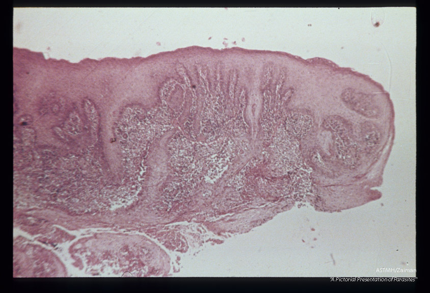 (South America). Hematoxylin-eosin stained section through papillomatous lesion with diffuse infiltration of dermis.