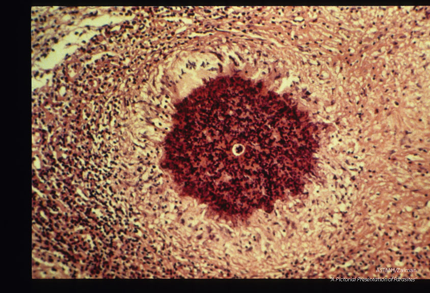 Larva within a granuloma in a detached human retina.