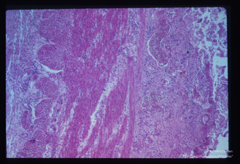 Chronic inflammatory response in region of bowel ulcer.