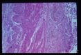 Chronic inflammatory response in region of bowel ulcer.