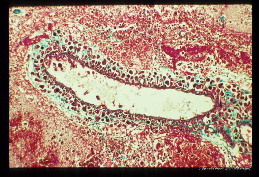 Perivascular cuffing by amoebae. Occipital lobe. Masson trichrome stain.