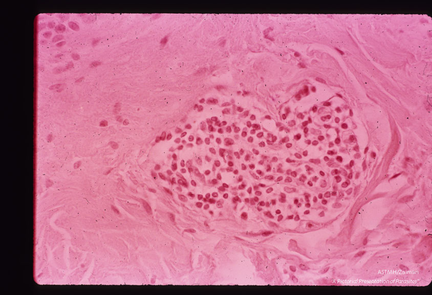 Inflammatory reaction within dermis.