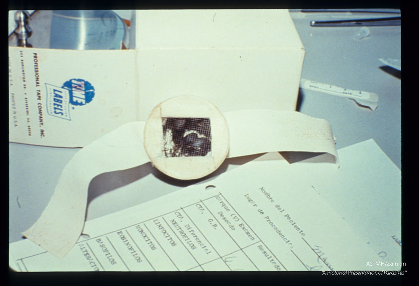 Sequence shows an empty cage (1114) within which are placed uninfected reduviid bugs for xenodiagnosis. This is attached to the forearm with tape (1115). The bugs are permitted to bite the patient, are removed (1116), maintained for a while, then sacrificed. Proctodeum is then dissected for parasites.