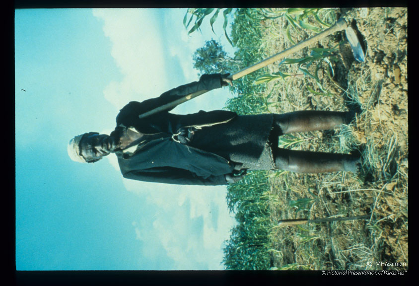 Tanzania. Elephantiasis of lower extremities. Old man continues working in corn field in spite of deformity.