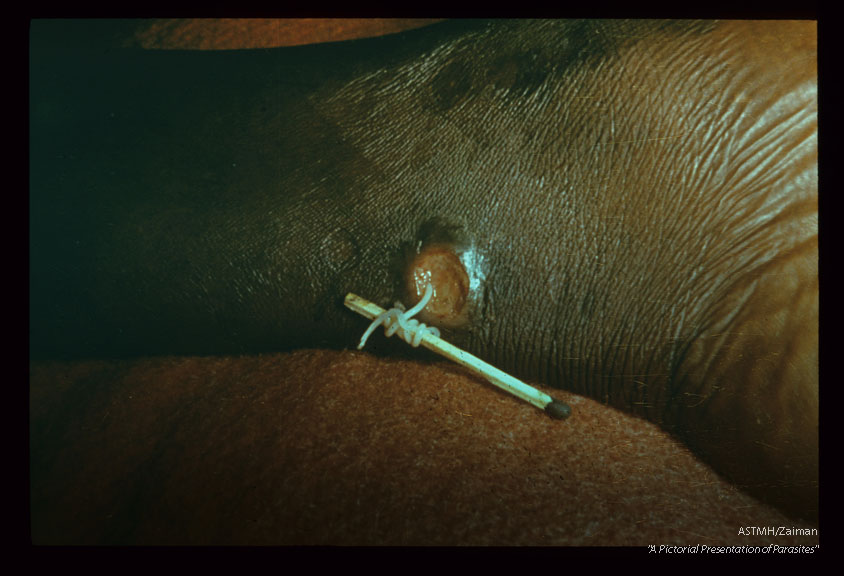 Extracting worms by classical match stick technique.