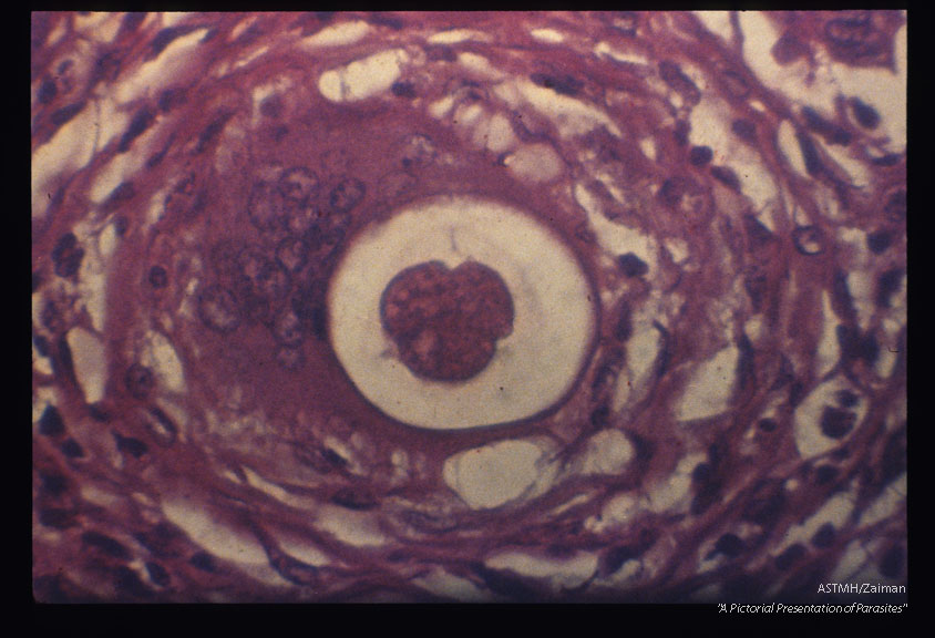 Abdominal mass which contained adult Ascaris (1407, 1408) and eggs (1409) was surgically removed from a patient. There was direct communication with the large bowel. Note cell division in the egg (1409).