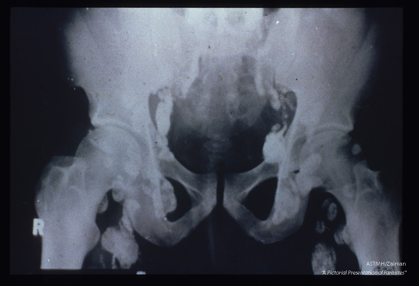 Lymphadenopathy demonstrated by x-ray.