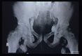 Lymphadenopathy demonstrated by x-ray.