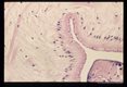 Multiple sections through subcutaneous human tissue containing a sparganum and through the sparganum itself. Note the tremendous inflammatory reaction.