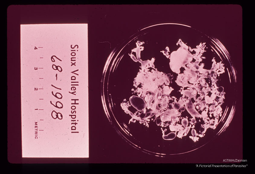 A 32 month old white male in South Dakota suffered progressive lassitude,   anorexia,   irritability,   incoordination and infrequent vomiting.  A suboccipital craniotomy was performed during which a grape-like mass of translucent thin wall cysts was discovered and partially evacuated with difficulty.  Subsequently patient developed flexion rigidity of the  extremities,  non-reactive pupils and decreased consciousness.  A sinus tract at the operative site con­tained more cysts.  The patient died three months after the onset of symptoms. Cysts removed from patient.