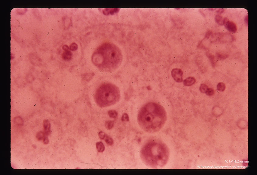 Lee case of primary amoebic meningo encephalitis. Olfactory bulb smear 3 August. Hematoxylin stain.