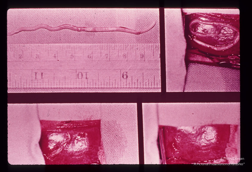 A 3 1/2 year old Caucasian male from Southeastern West Virginia was seen in semi-comatose state, exhibiting weight loss, jaundice, fever, nystagmus, enlarged knobby liver, and pulmonary infiltrate. WBC was 21,400 of which 18% were eosinophiles. Adult scaris were seen in stools. Patient responded to corticosteroid therapy and recovered slowly following exploratory surgery. Liver biopsy showed Ascaris eggs and eosinophilic granulomata.