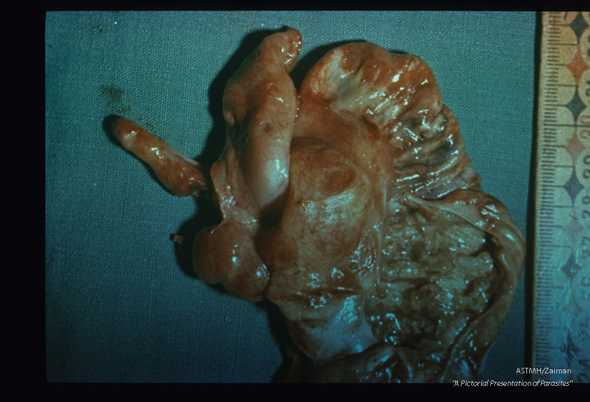 Fifteen month old child. Autopsy specimen showing cecum with ulcerations.
