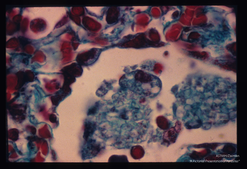 Pneumonia. Oil immersion views of alveoli stained by the Wheatly modification of trichrome for stools showing numerous parasites within "honeycomb" material. Parasitic nuclear material and limiting membranes stain well. There is active proliferation of alveolar macrophages and evidence of phagocytosis.