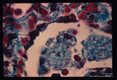 Pneumonia. Oil immersion views of alveoli stained by the Wheatly modification of trichrome for stools showing numerous parasites within 