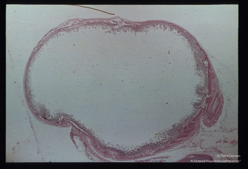 Gross pathology. Cross section of human gut showing atrophy of mucous layer.