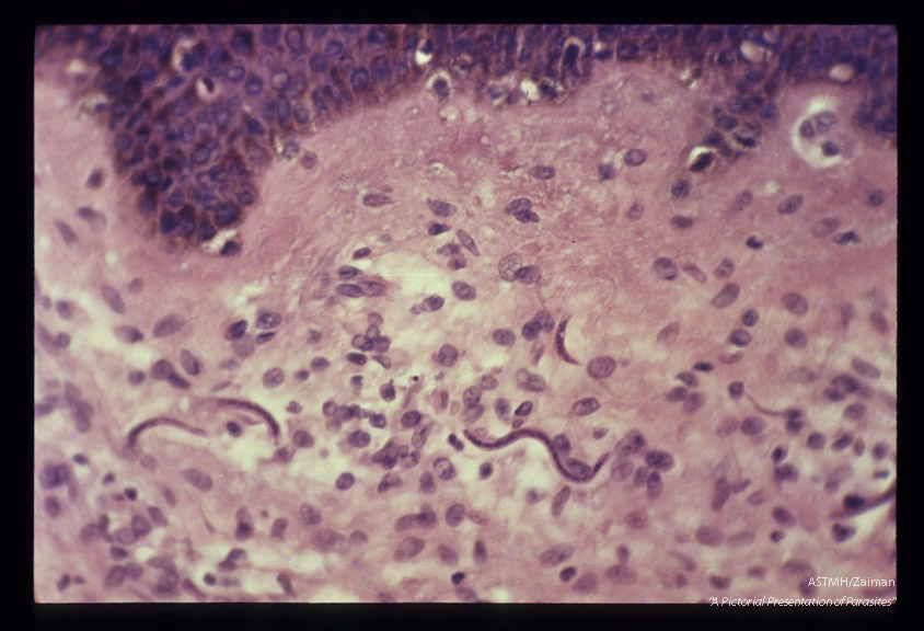 Microfilariae in subcutaneous tissue.