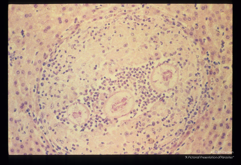 Larval granuloma in the liver of an experimentally infected squirrel monkey.