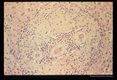 Larval granuloma in the liver of an experimentally infected squirrel monkey.