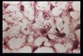 (South America), Hematoxylin-eosin stained section of pseudo-lepromatous lesion showing Leishmania.