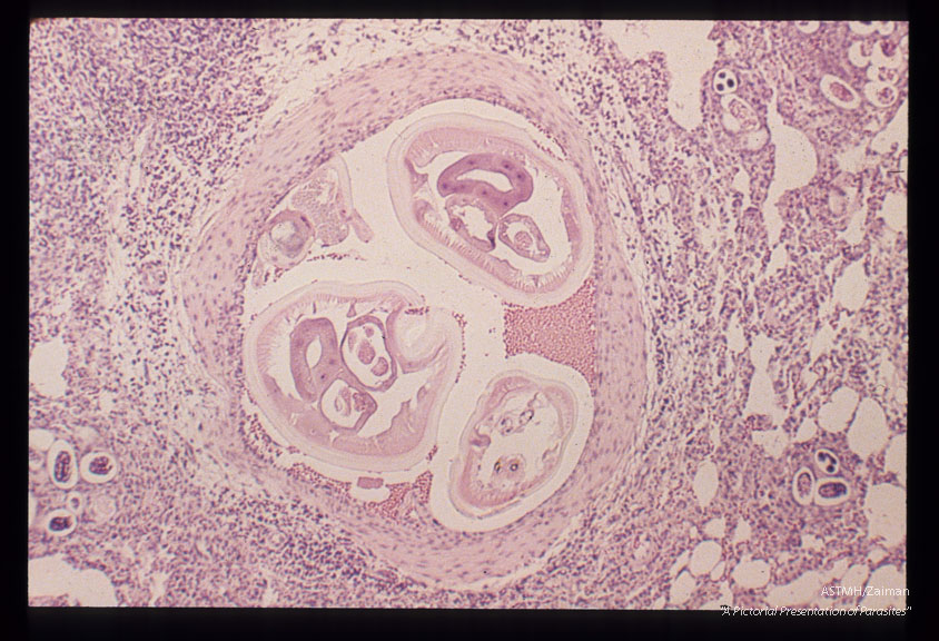 Microscopic views of rat lung reaction to the nematodes.