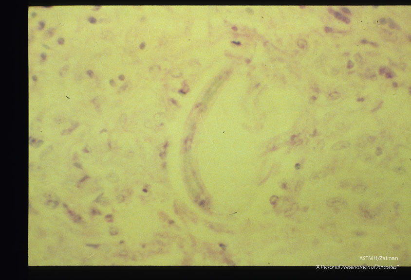 Brain sections from a young male adult who died suddenly and unexpectedly in an institution for the retarded. Larva and brain reaction are well shown.