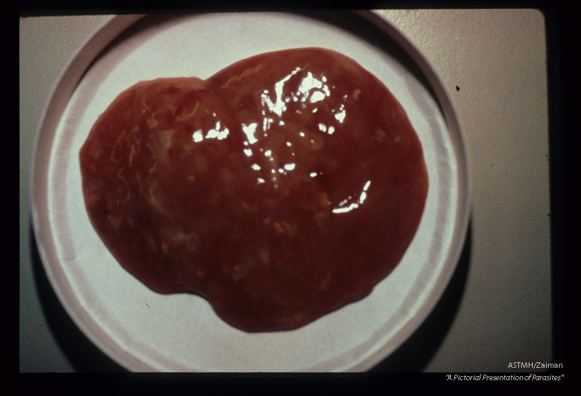 Contents drained from lung abscess.