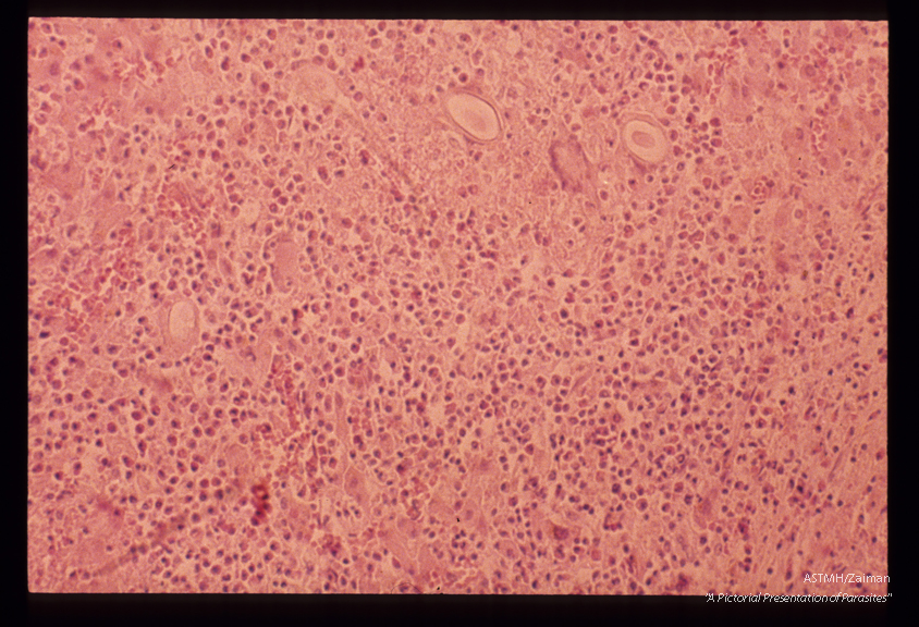 Eggs in human liver. The eggs are seen in the upper mid-portion of the slide. There is considerable tissue destruction and an infiltrate which is predominantly eosinophilic.