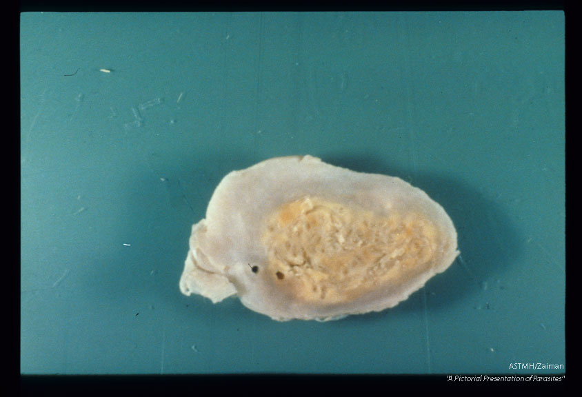 Nodule with surrounding subcutaneous tissues.