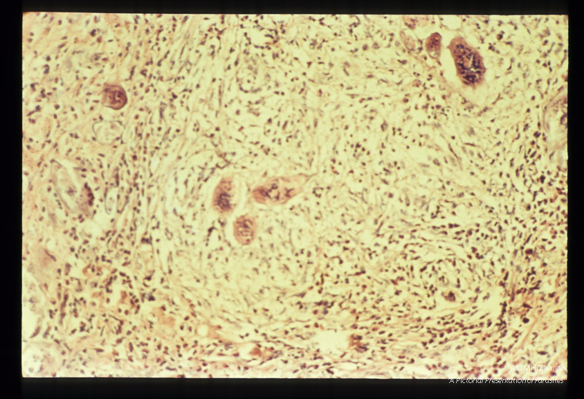 Adults and ova in human testicle.