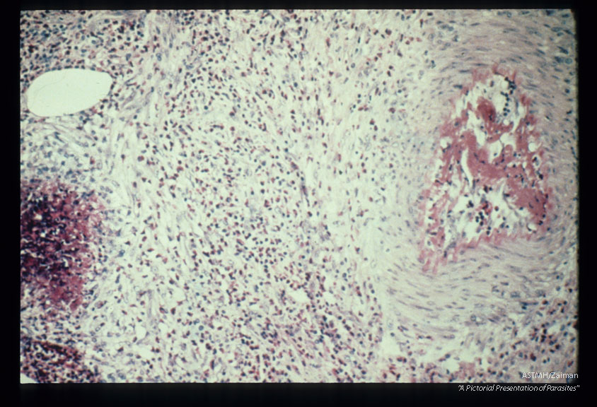 Multiple sections through anisakid nematodes and inflammatory infiltrate they induced in a human cecum.