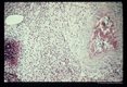 Multiple sections through anisakid nematodes and inflammatory infiltrate they induced in a human cecum.