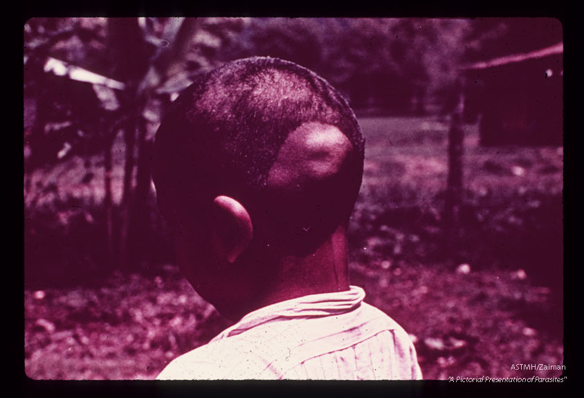 Nodules in scalp and forehead.