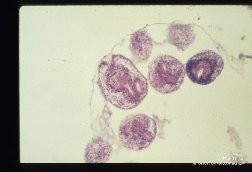 Germinal layer and scolices from the same case.