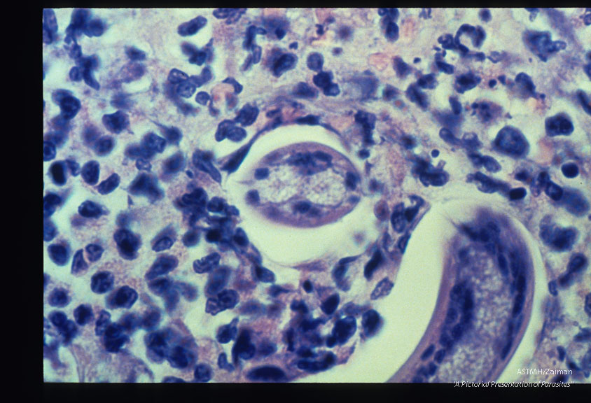 High power view of a cat liver granuloma with larva surrounded by eosinophils.