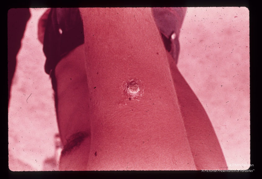Immunization by induced lesion in a young Soviet worker in Kirovabad area of Azerbaijan, USSR. In southern U.S.S.R. the "Large Gerbil, " Thombomys apimus, which lives in vast subteranian chambers like our prairie dog, serves as a reservoir host for the zoonotic form of .Leishmania tropica. associated with "wet lesions". in that area.