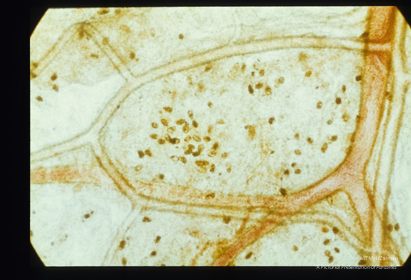 Paragonimus eggs are present in the mediastinum.