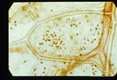 Paragonimus eggs are present in the mediastinum.