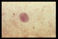 Cysts in stool, showing various numbers of nuclei, hematoxylin stain.