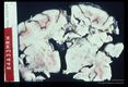 A one and one half year old boy died after a 3 week bout of CNS disease. Brain shows peri-ventricular necrosis and softening.